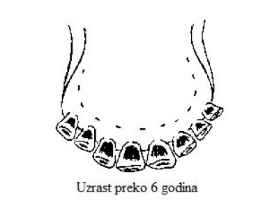 Starost preko 6 godina (trošenje zuba) Starost preko 6 godina (trošenje zuba)