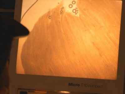 Trihineloza je neizlečiva