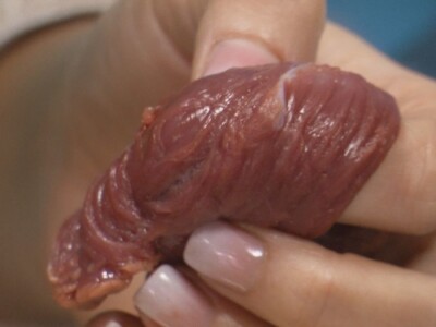 Trihineloza je neizlečiva