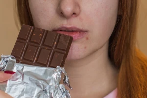 Da li je čokolada krivac za pojavu akni?